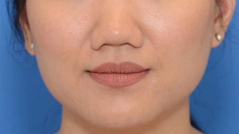 Botox - Patient 6 (front view before)