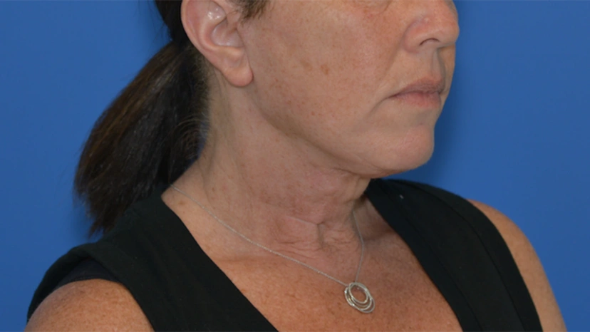 Facelift - Patient 6 (after)