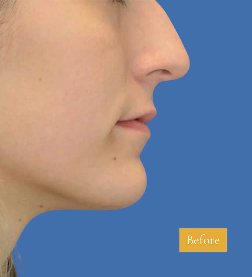 Rhinoplasty - Patient 8 (before)