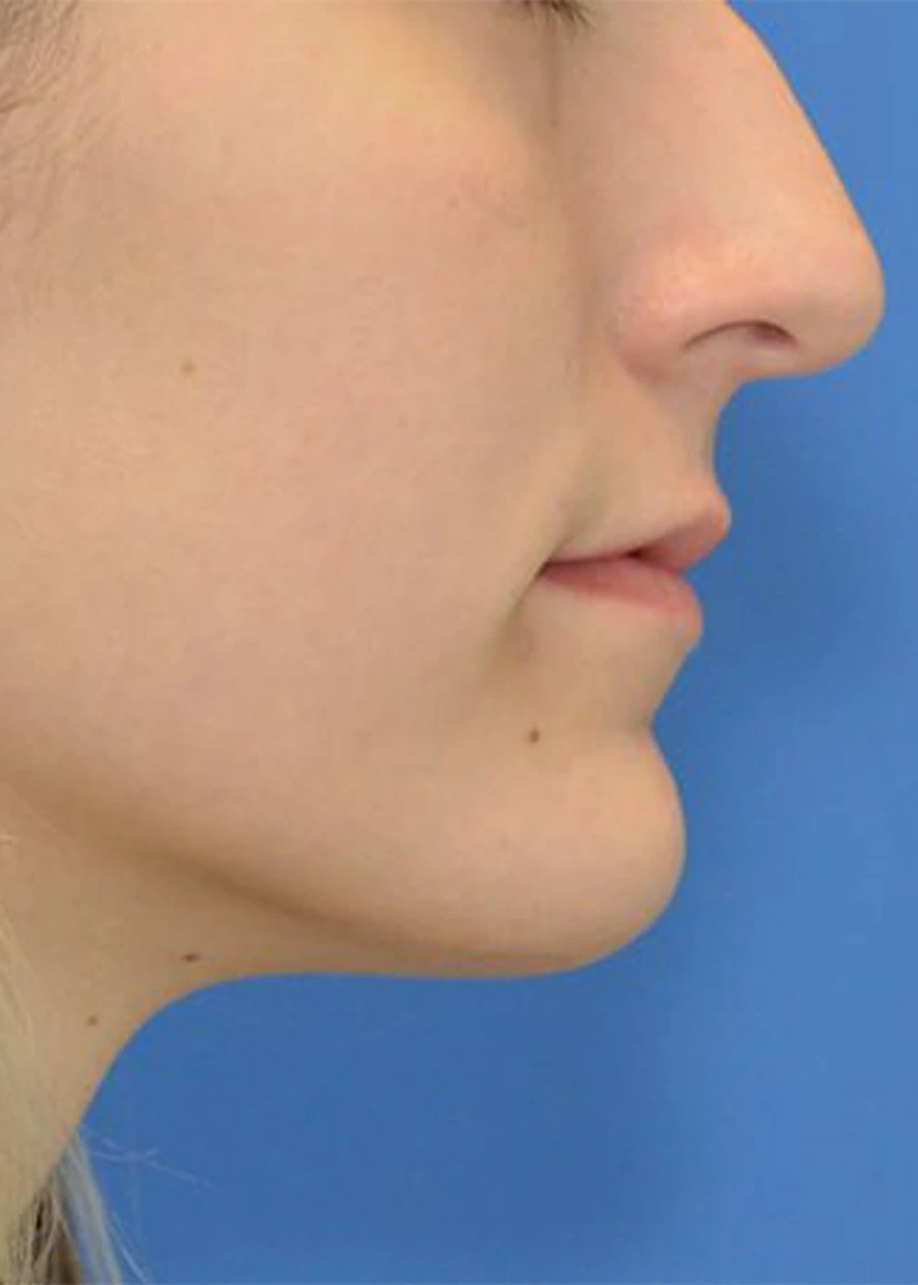 Rhinoplasty - Patient 8 (before)