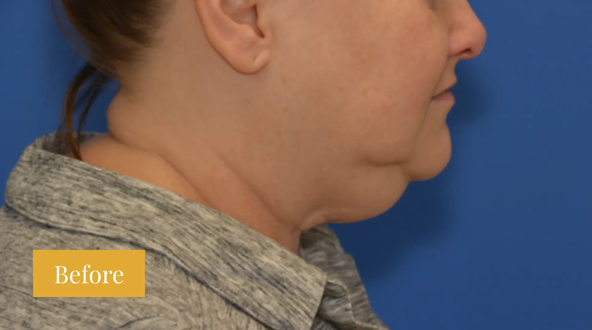 Before Facelift before and after