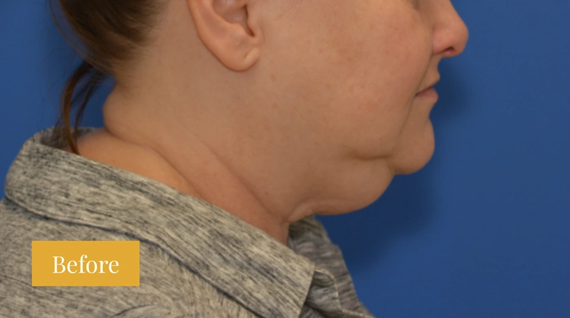 Facelift - Patient 13 - Set 1 - Before