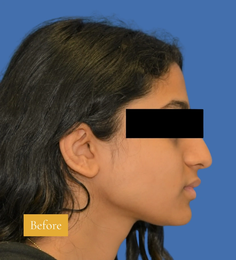 Facelift - Patient 13 - Set 1 - Before