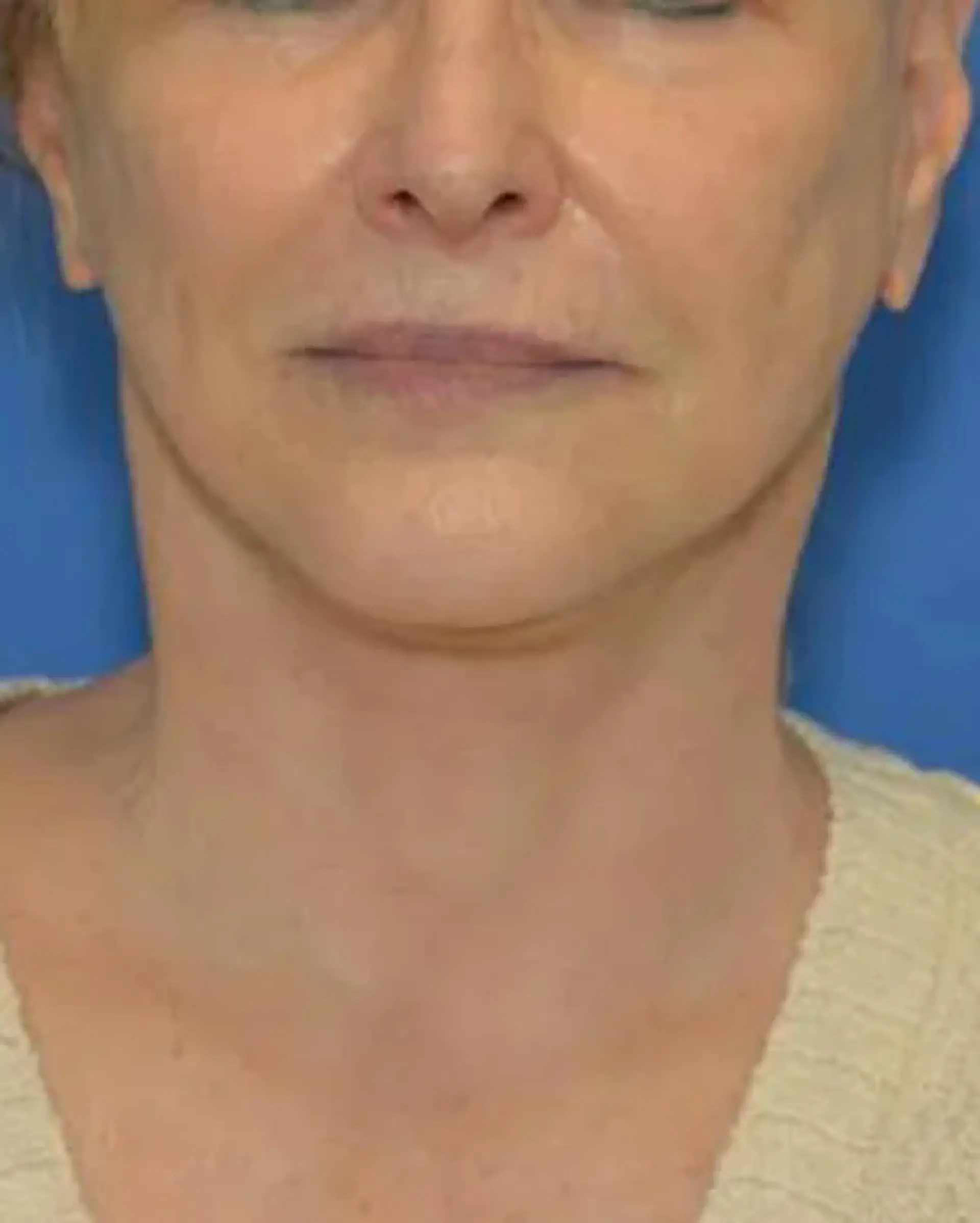 After Facelift before and after