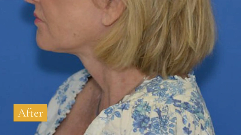 Facelift - Patient 5 (after)