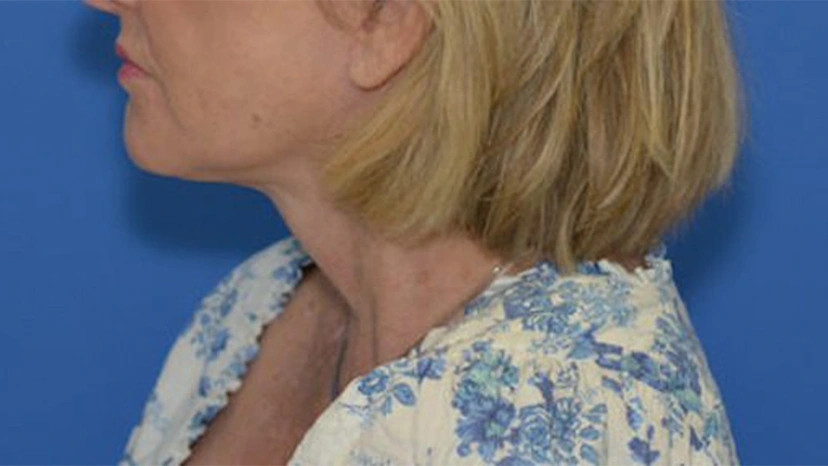 Facelift - Patient 5 (after)