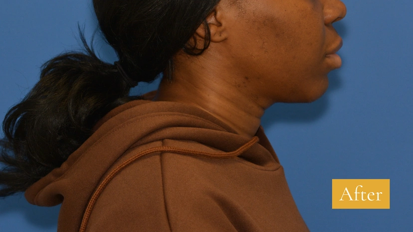 Chin Augmentation after side-left patient 1