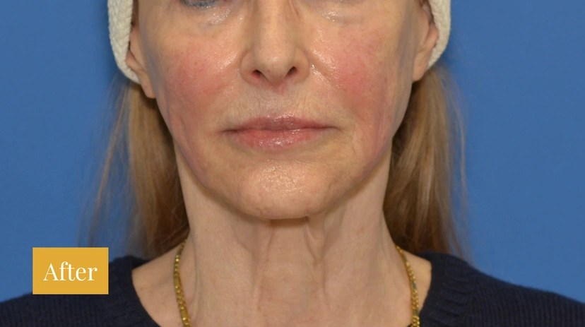 Dermal Fillers - Patient 5 - Set 1 - After