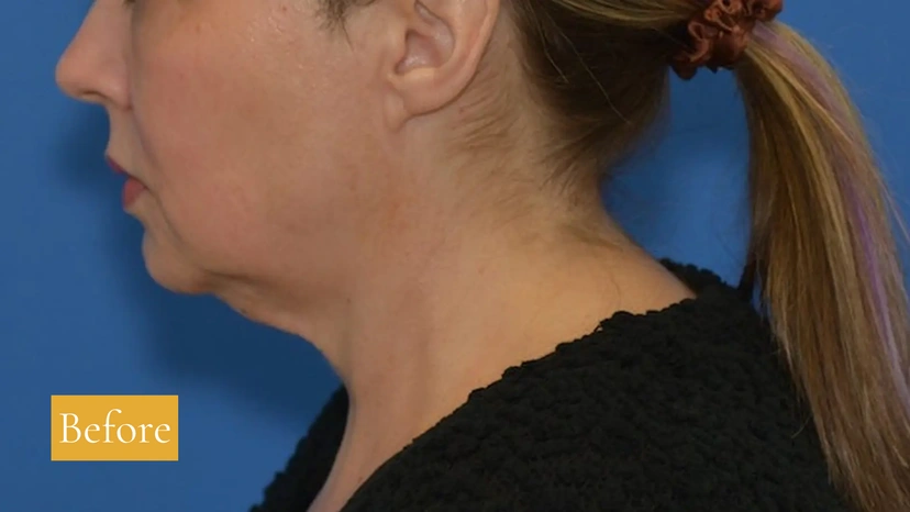 Morpheus8 RF Microneedling - Patient 7 (before)