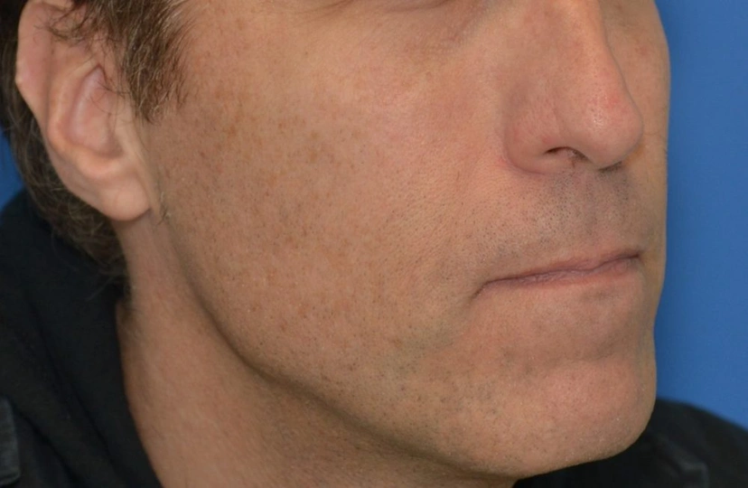 Sculptra - Patient 1 (after)