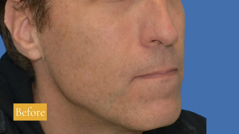 Sculptra - Patient 1 (after)