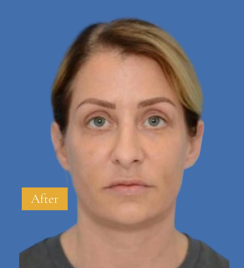 Upper Eyelid Surgery - Patient 4 (front view after)