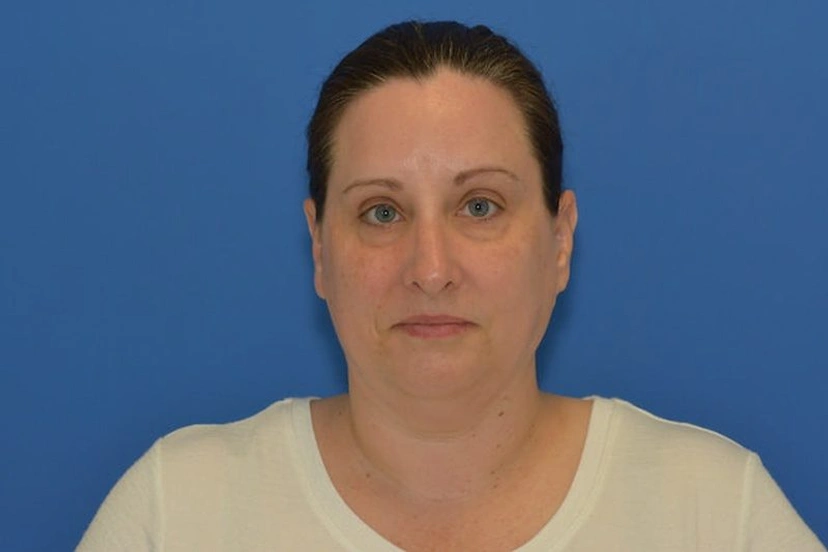 Morpheus8 RF Microneedling - Patient 9 (before)