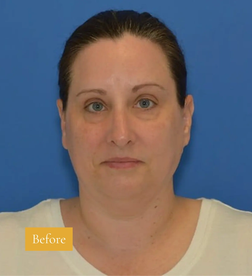 Morpheus8 RF Microneedling - Patient 9 (before)