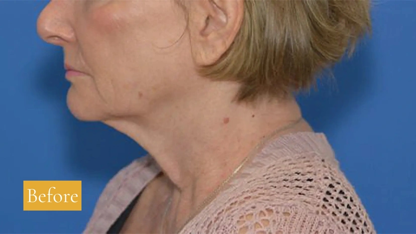 Facelift - Patient 5 (before)