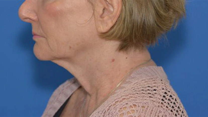 Facelift - Patient 5 (before)