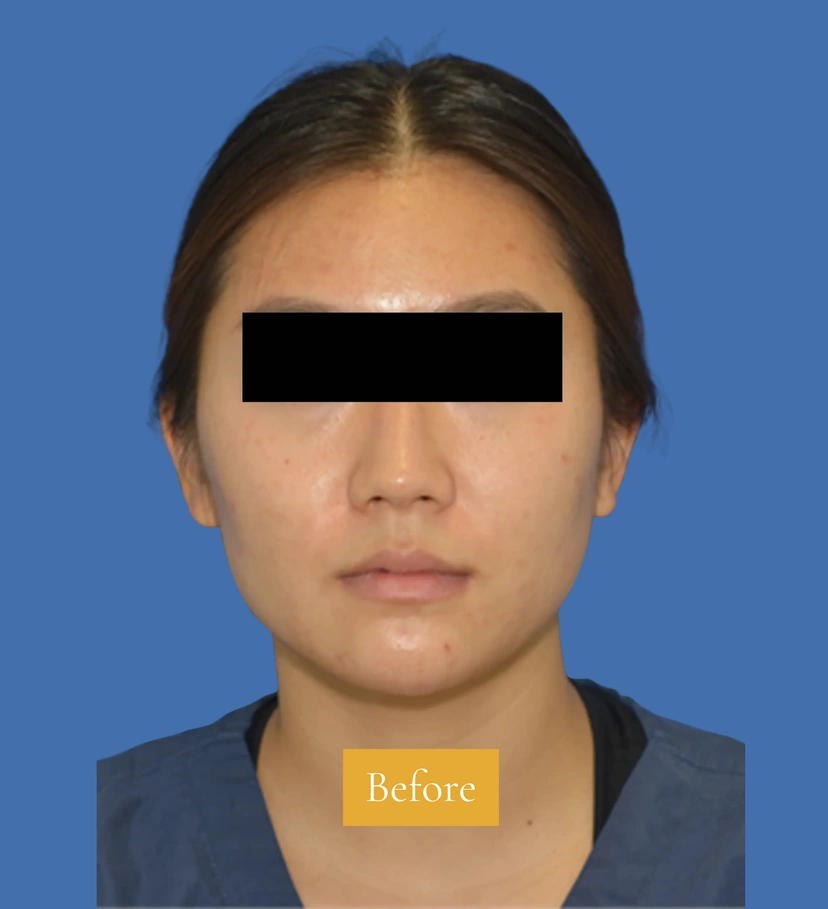 Botox - Patient 4 (front view before)