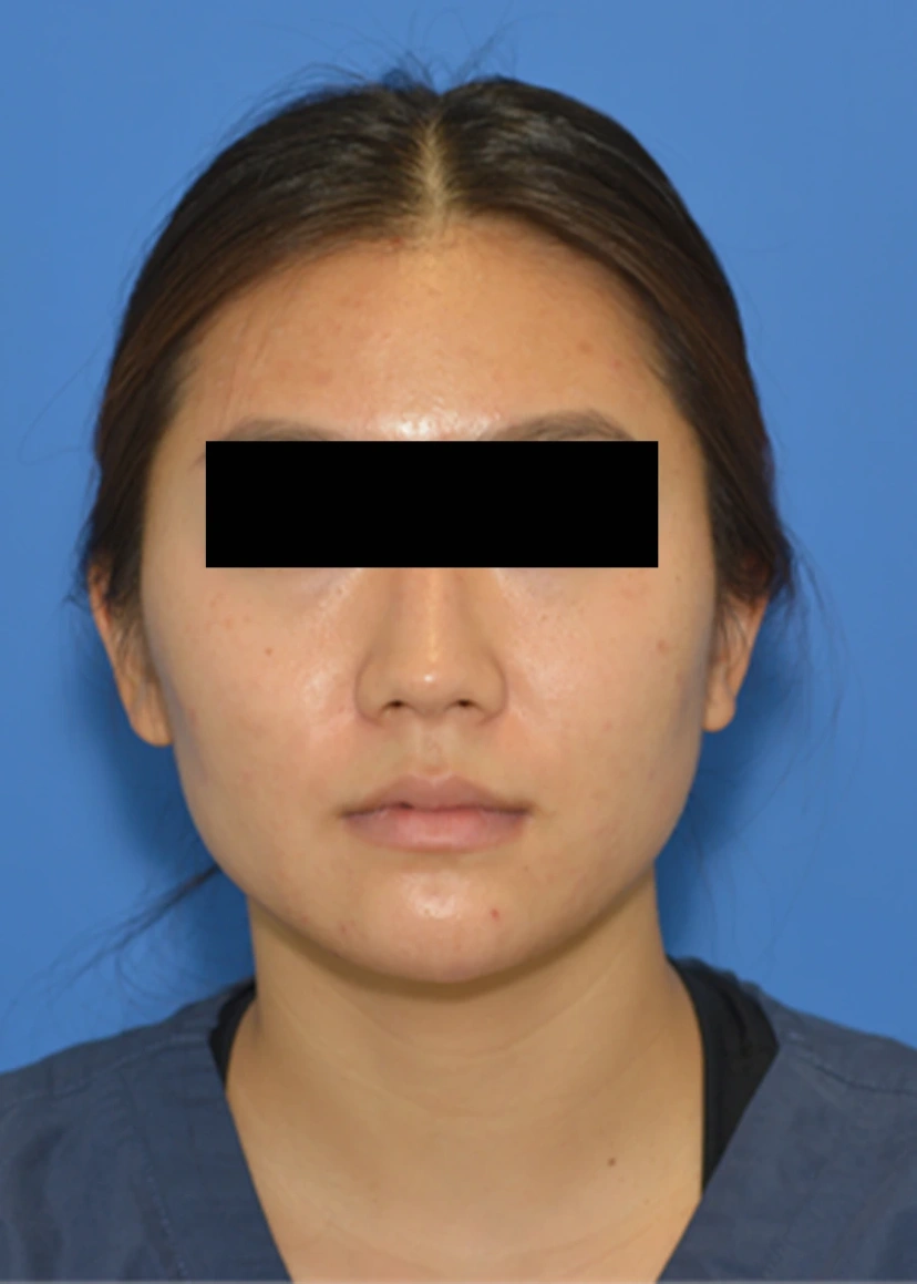 Botox - Patient 4 (front view before)