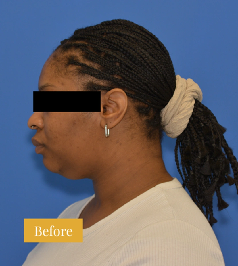 Chin Liposuction - Patient 2 - Set 1 - Before