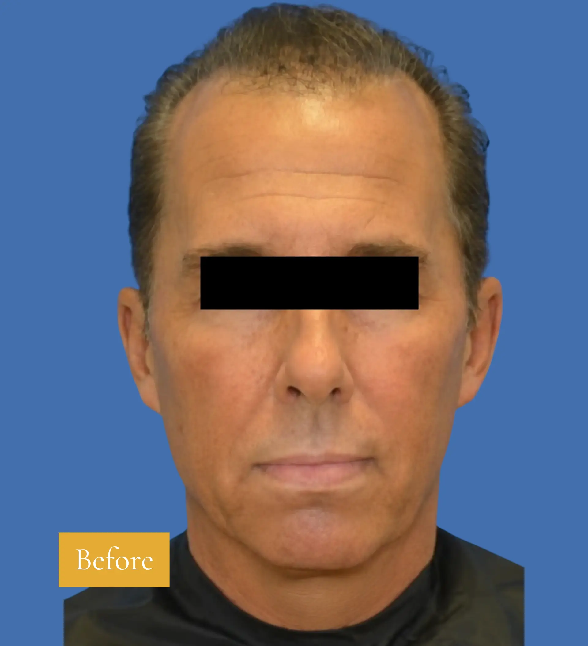 Before Mini Facelift before and after