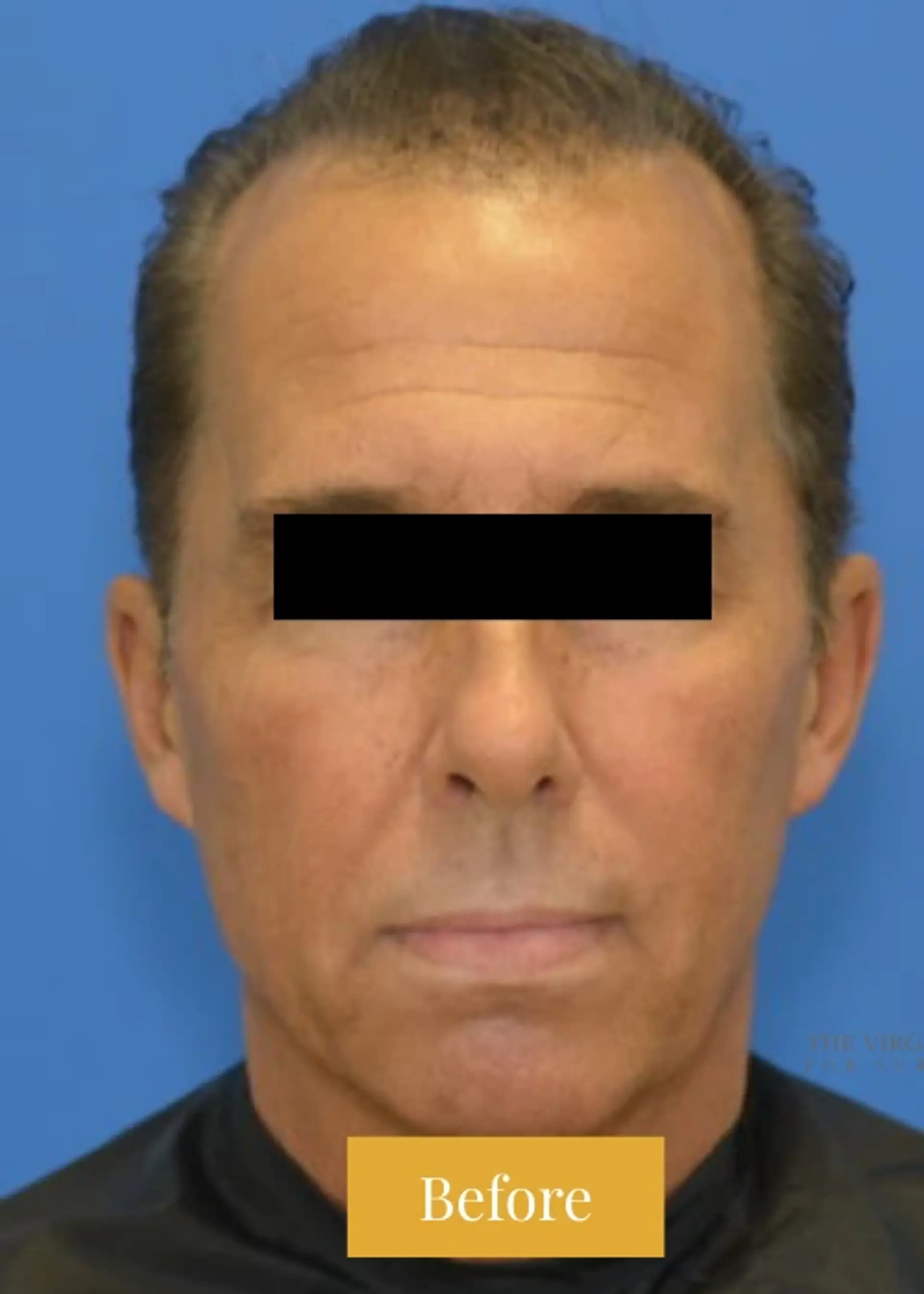 After Facelift before and after