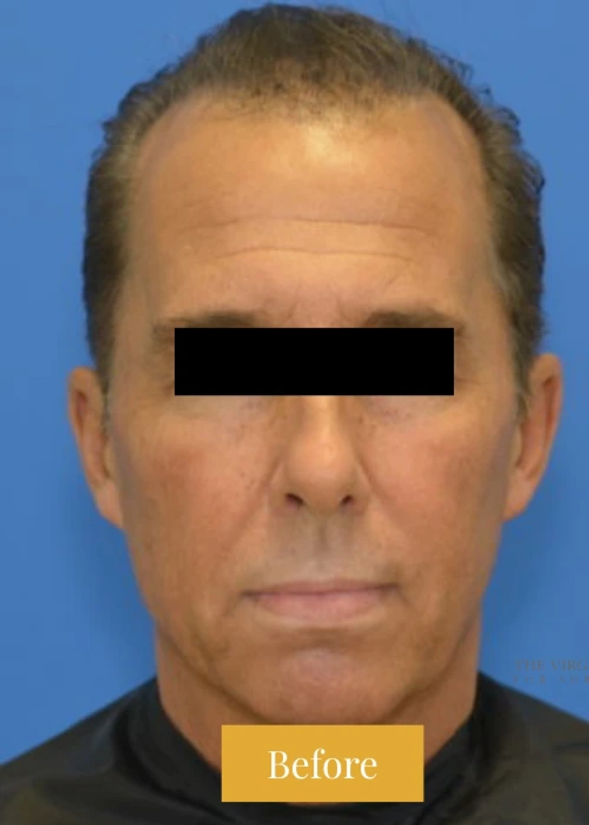 Mini Facelift/Short Scar - Patient 6 (before)