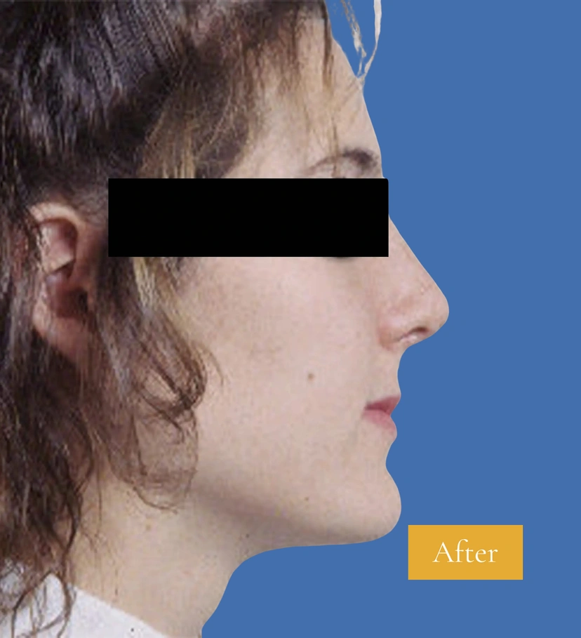 Rhinoplasty - Patient 4 (after)