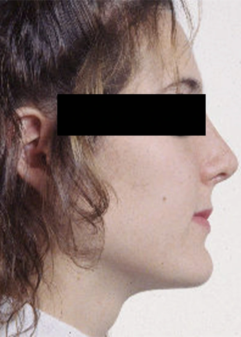 Rhinoplasty - Patient 4 (after)