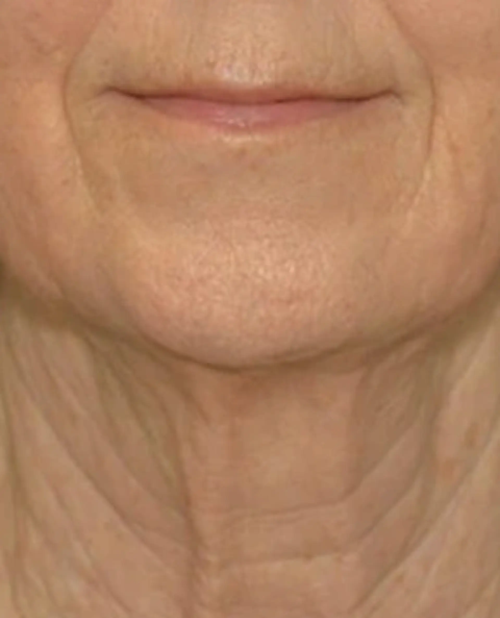 After Facial Plastic Surgery Before and After Photos