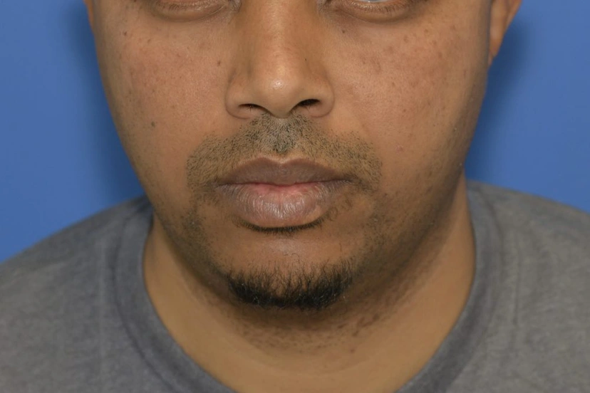 Microneedling - Patient 2 (after)