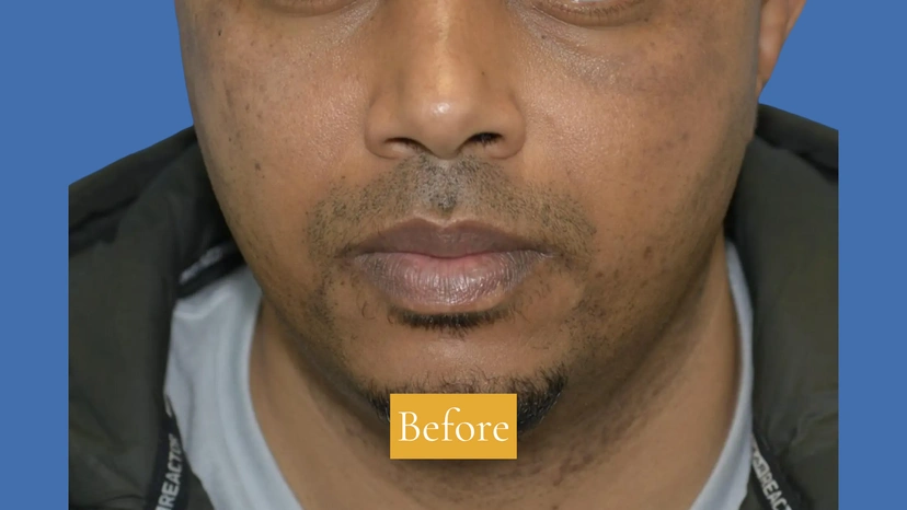 Microneedling - Patient 2 (after)