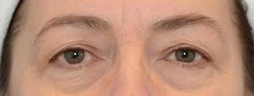 Upper Eyelid Surgery - Patient 2 (before)
