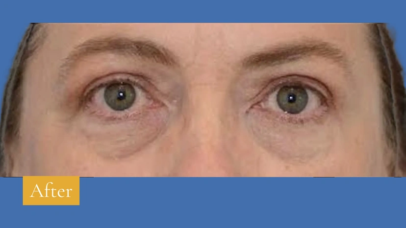 Upper Eyelid Surgery - Patient 2 (before)