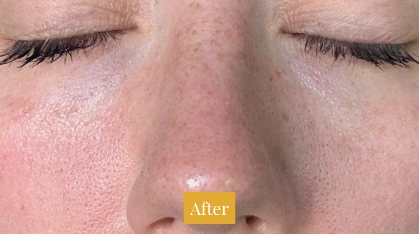 Fraxel - Patient 2 - Set 1 - After