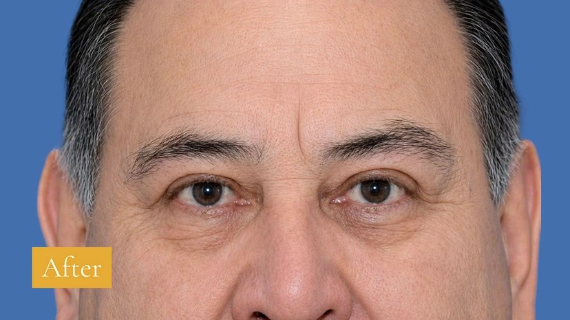 Eyebrow Lift - Patient 1 (after)