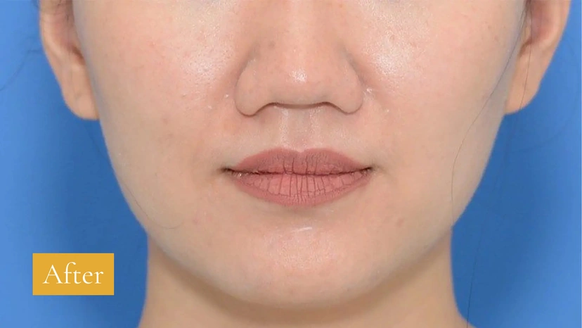 Botox - Patient 6 (front view after)