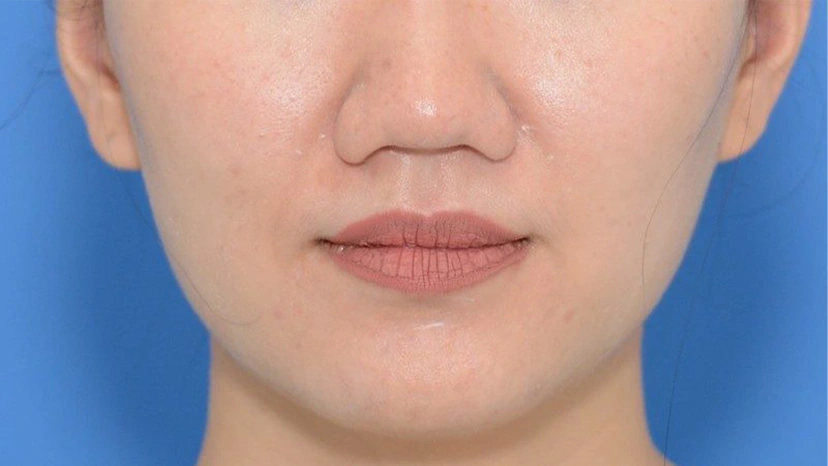 Botox - Patient 6 (front view after)