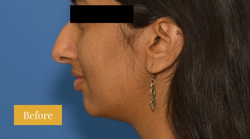 Rhinoplasty - Patient 10 - Set 1 - Before