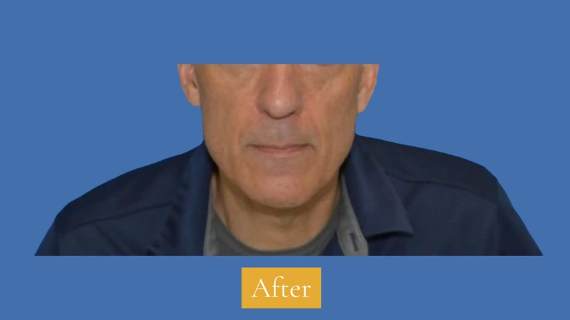 Dermal Fillers - Patient 2 (after)