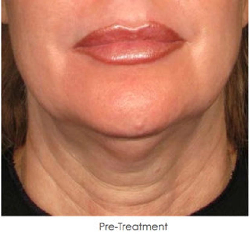 Ultherapy patient 5 result photo