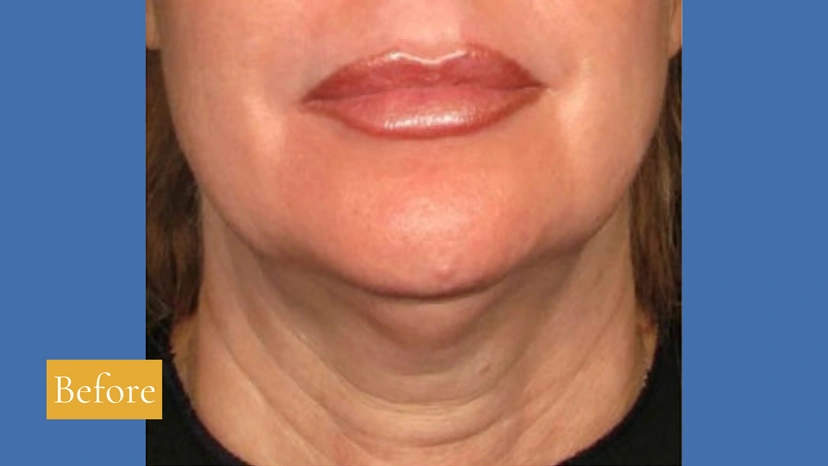 Ultherapy patient 5 result photo